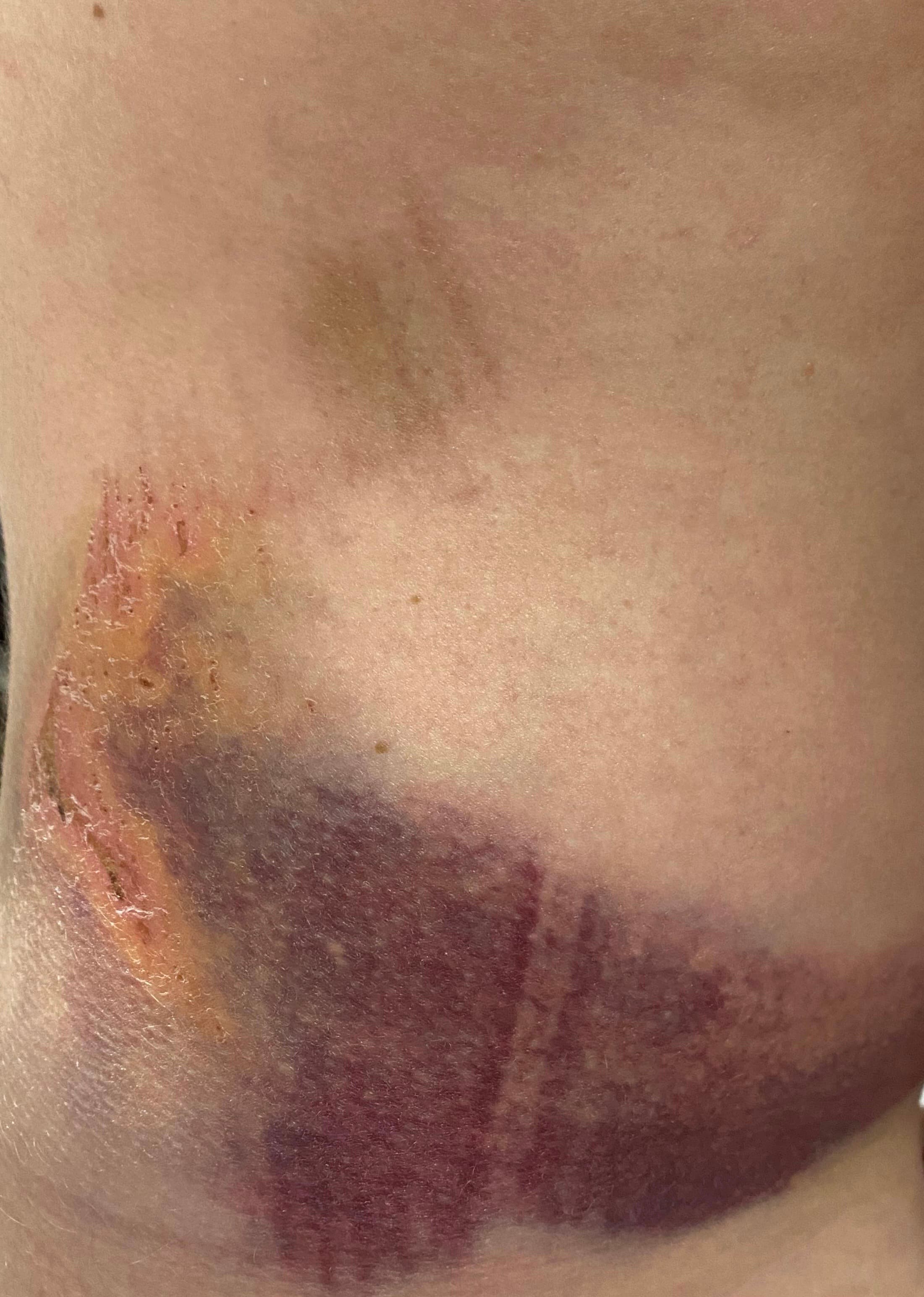 The hip bruise from the La Concha fall